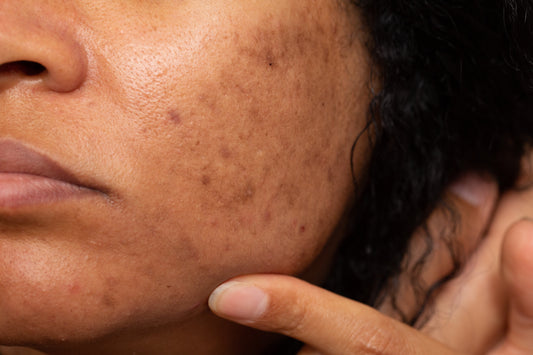 Erase Dark Spots for Good — Proven Esthetician Secrets to Even-Toned Skin